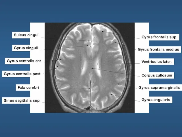 Sulcus cinguli Gyrus cinguli Gyrus centralis ant. Gyrus centralis post. Falx