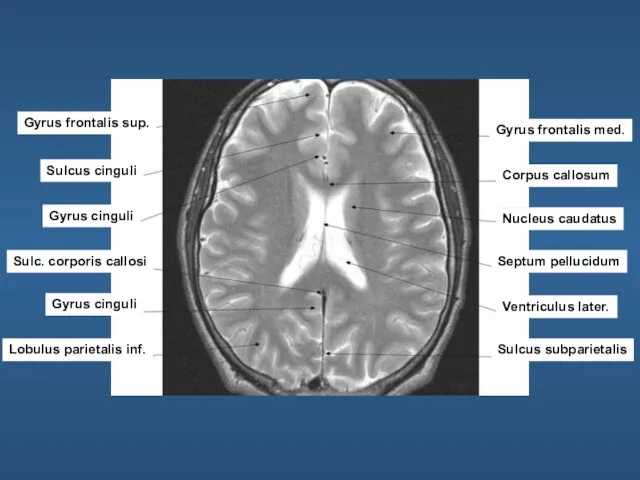 Gyrus frontalis sup. Sulcus cinguli Gyrus cinguli Sulc. corporis callosi Gyrus