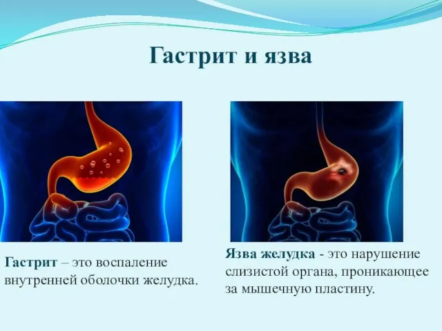 Гастрит и язва Гастрит – это воспаление внутренней оболочки желудка. Язва