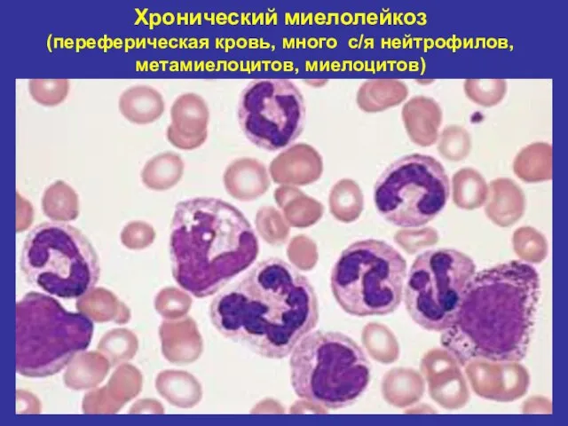 Хронический миелолейкоз (переферическая кровь, много с/я нейтрофилов, метамиелоцитов, миелоцитов)