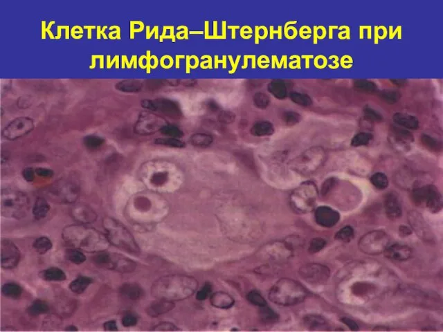 Клетка Рида–Штернберга при лимфогранулематозе
