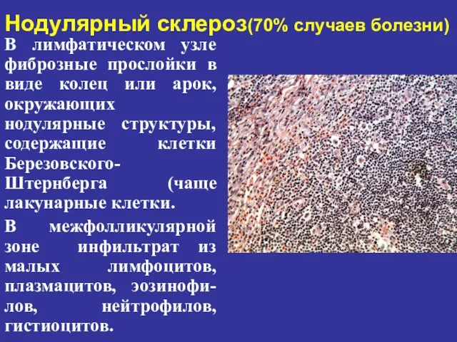 Нодулярный склероз(70% случаев болезни) В лимфатическом узле фиброзные прослойки в виде