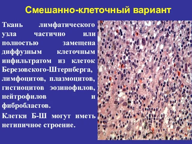 Смешанно-клеточный вариант Ткань лимфатического узла частично или полностью замещена диффузным клеточным