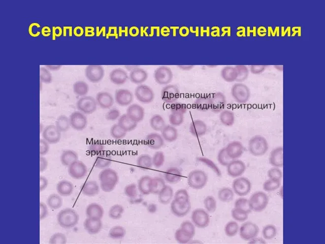 Серповидноклеточная анемия