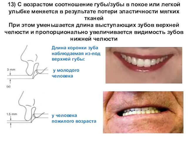   13) С возрастом соотношение губы/зубы в покое или легкой