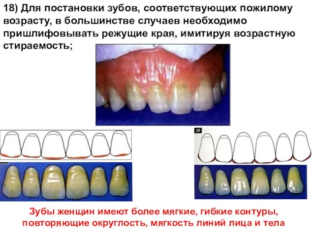 18) Для постановки зубов, соответствующих пожилому возрасту, в большинстве случаев необходимо