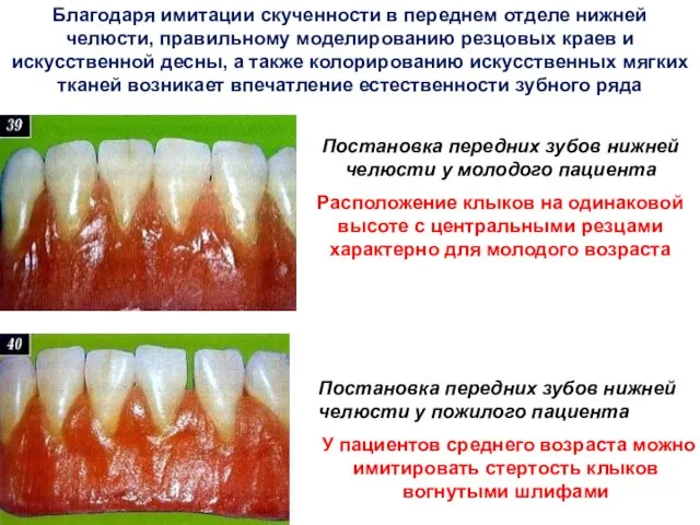 Благодаря имитации скученности в переднем отделе нижней челюсти, правильному моделированию резцовых