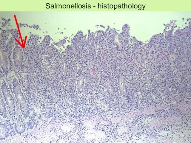 Salmonellosis - histopathology