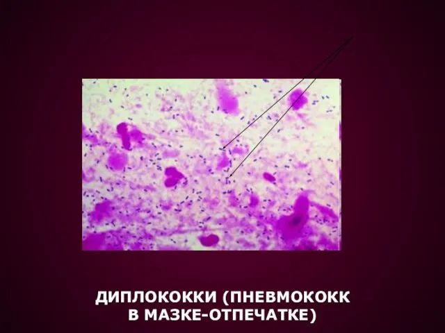 ДИПЛОКОККИ (ПНЕВМОКОКК В МАЗКЕ-ОТПЕЧАТКЕ)