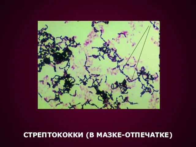 СТРЕПТОКОККИ (В МАЗКЕ-ОТПЕЧАТКЕ)