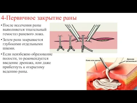 4-Первичное закрытие раны После иссечения раны выполняется тщательный гемостаз раневого ложа.