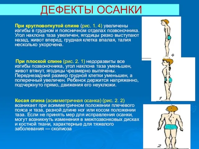 ДЕФЕКТЫ ОСАНКИ При кругловогнутой спине (рис. 1. 4) увеличены изгибы в