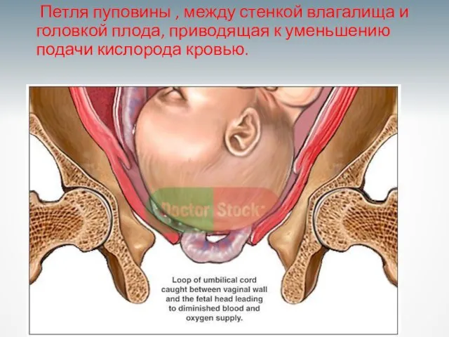 Петля пуповины , между стенкой влагалища и головкой плода, приводящая к уменьшению подачи кислорода кровью.