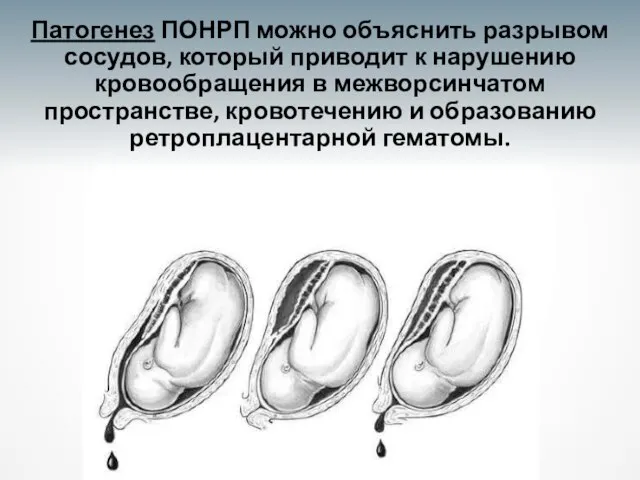 Патогенез ПОНРП можно объяснить разрывом сосудов, который приводит к нарушению кровообращения