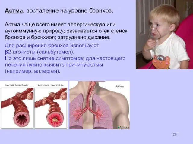 Астма: воспаление на уровне бронхов. Астма чаще всего имеет аллергическую или