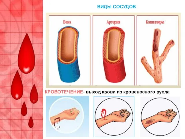 КРОВОТЕЧЕНИЕ- выход крови из кровеносного русла ВИДЫ СОСУДОВ