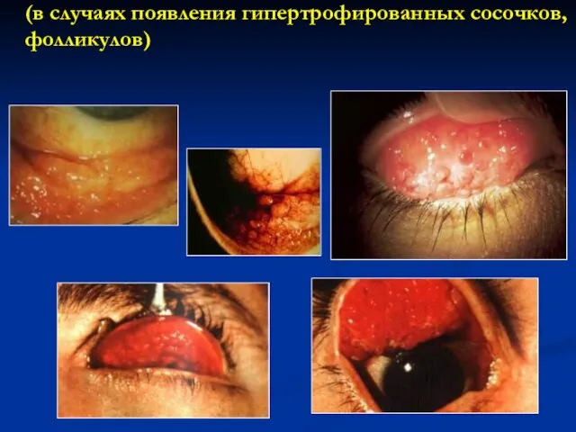 шероховатости конъюнктивы век (в случаях появления гипертрофированных сосочков, фолликулов)