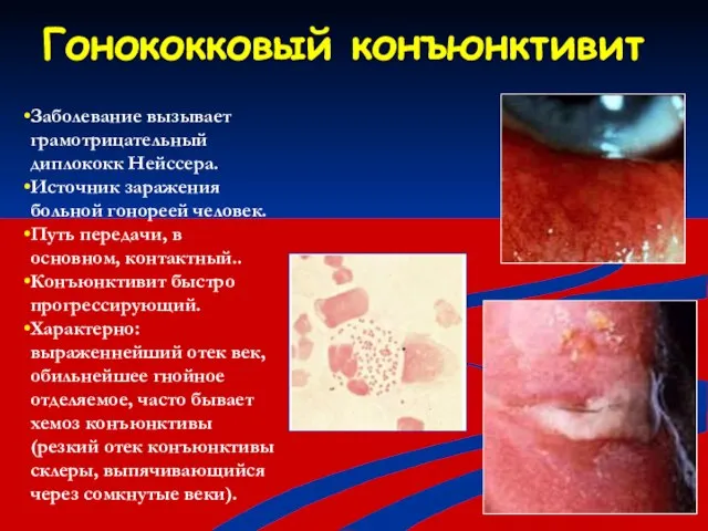 Гонококковый конъюнктивит Заболевание вызывает грамотрицательный диплококк Нейссера. Источник заражения больной гонореей