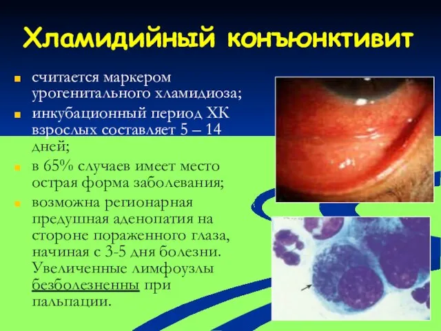 Хламидийный конъюнктивит считается маркером урогенитального хламидиоза; инкубационный период ХК взрослых составляет