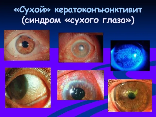 «Сухой» кератоконъюнктивит (синдром «сухого глаза»)