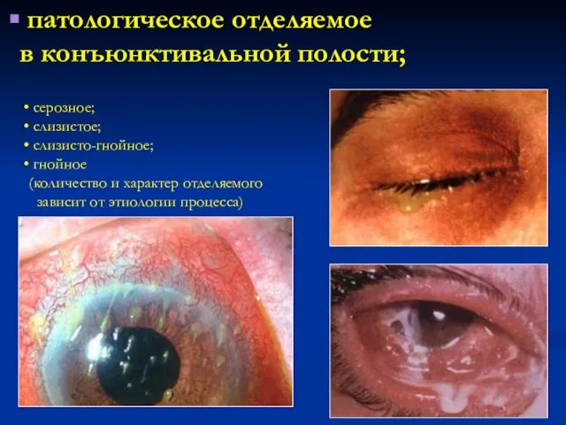 патологическое отделяемое в конъюнктивальной полости; серозное; слизистое; слизисто-гнойное; гнойное (количество и