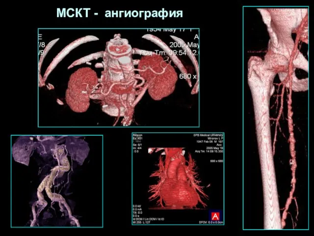 МСКТ - ангиография