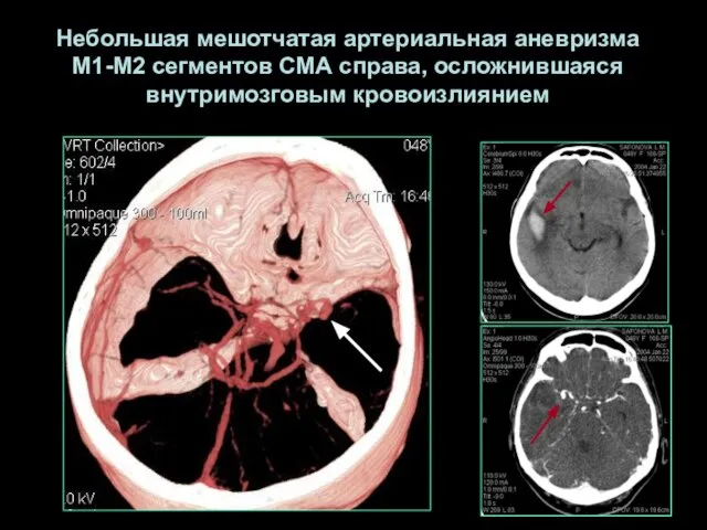 Небольшая мешотчатая артериальная аневризма М1-М2 сегментов СМА справа, осложнившаяся внутримозговым кровоизлиянием