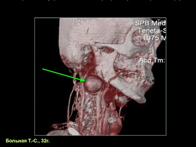 Аневризма внутренней сонной артерии при синдроме Марфана Больная Т.-С., 32г.