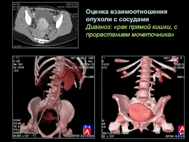 Оценка взаимоотношения опухоли с сосудами Диагноз: «рак прямой кишки, с прорастанием мочеточника»