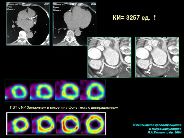 «Регионарное кровообращение и микроциркуляция» Л.А.Тютин, и др. 2004 ПЭТ с N-13аммонием