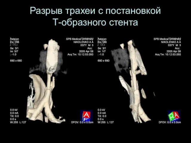 Разрыв трахеи с постановкой Т-образного стента