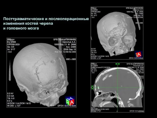 Посттравматические и послеоперационные изменения костей черепа и головного мозга