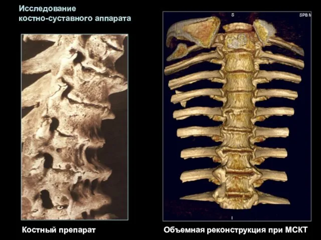 Костный препарат Объемная реконструкция при МСКТ Исследование костно-суставного аппарата