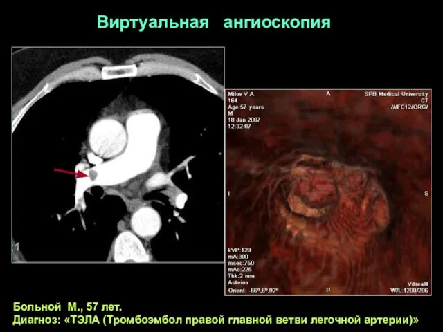 Больной М., 57 лет. Диагноз: «ТЭЛА (Тромбоэмбол правой главной ветви легочной артерии)» Виртуальная ангиоскопия