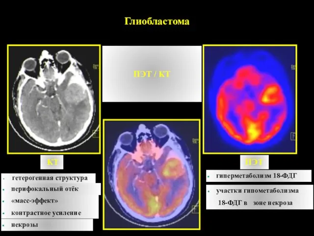 ПЭТ / КТ Глиобластома КТ ПЭТ гетерогенная структура перифокальный отёк «масс-эффект»