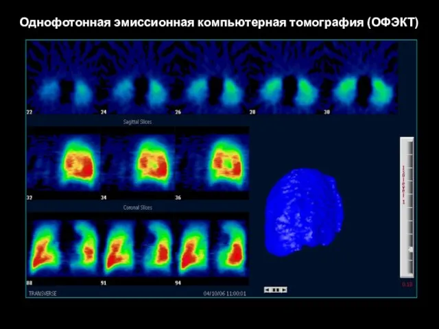 Однофотонная эмиссионная компьютерная томография (ОФЭКТ)