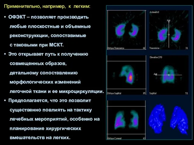 ОФЭКТ – позволяет производить любые плоскостные и объемные реконструккции, сопоставимые с