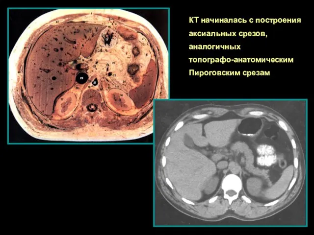 КТ начиналась с построения аксиальных срезов, аналогичных топографо-анатомическим Пироговским срезам