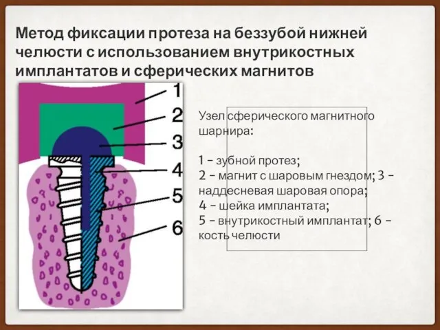 Метод фиксации протеза на беззубой нижней челюсти с использованием внутрикостных имплантатов