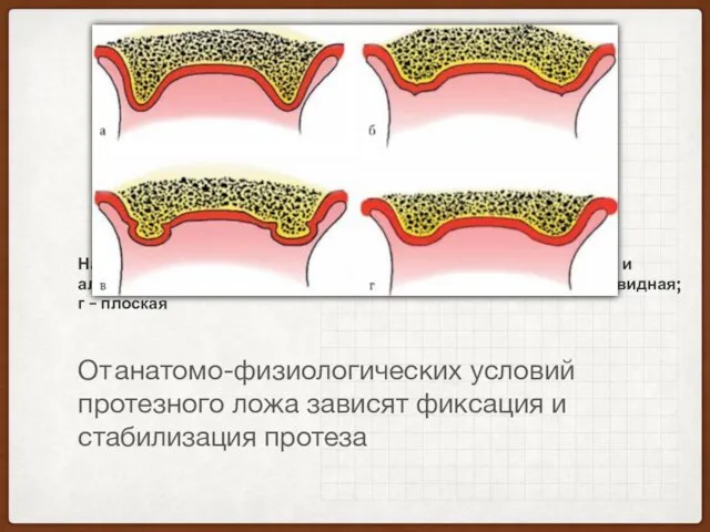 Наиболее часто встречающиеся формы альвеолярных отростков и альвеолярной части челюстей: а