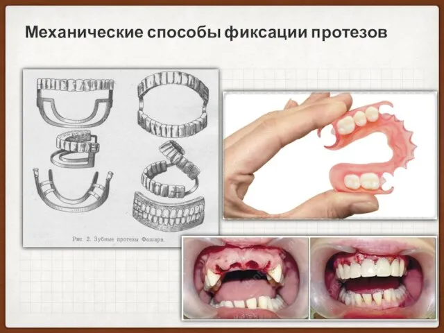 Механические способы фиксации протезов