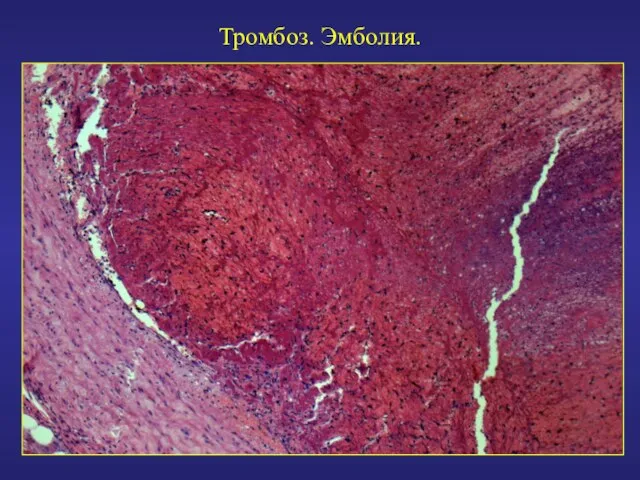 Тромбоз. Эмболия.