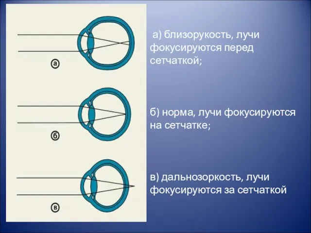 а) близорукость, лучи фокусируются перед сетчаткой; б) норма, лучи фокусируются на