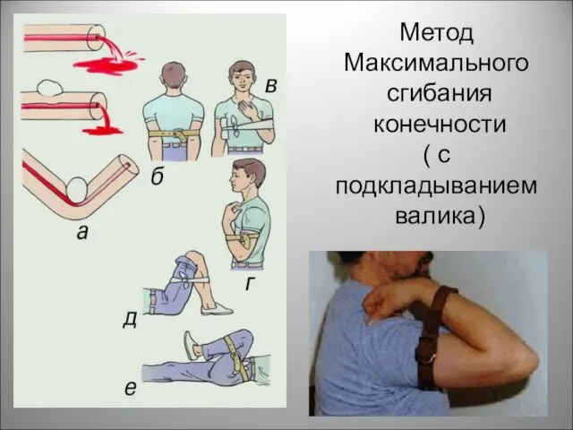 Метод Максимального сгибания конечности ( с подкладыванием валика)