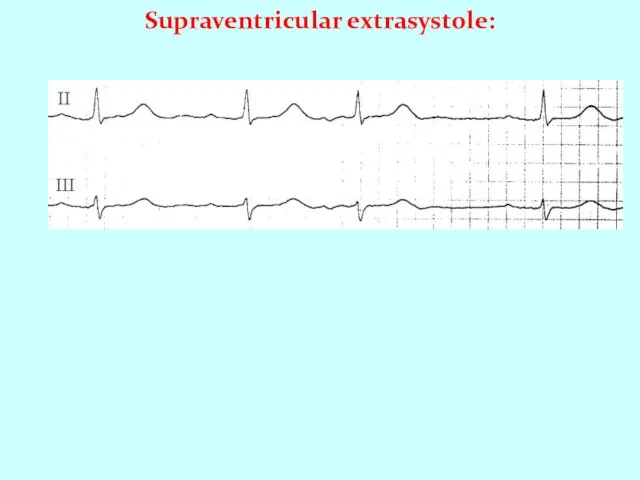 Supraventricular extrasystole: