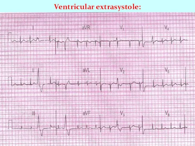 Ventricular extrasystole: