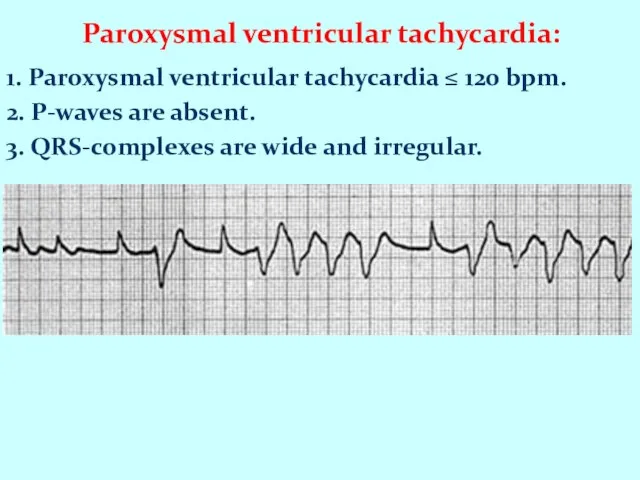 Paroxysmal ventricular tachycardia: 1. Paroxysmal ventricular tachycardia ≤ 120 bpm. 2.