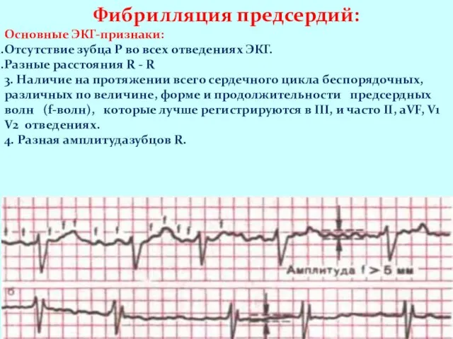 Фибрилляция предсердий: Основные ЭКГ-признаки: Отсутствие зубца Р во всех отведениях ЭКГ.