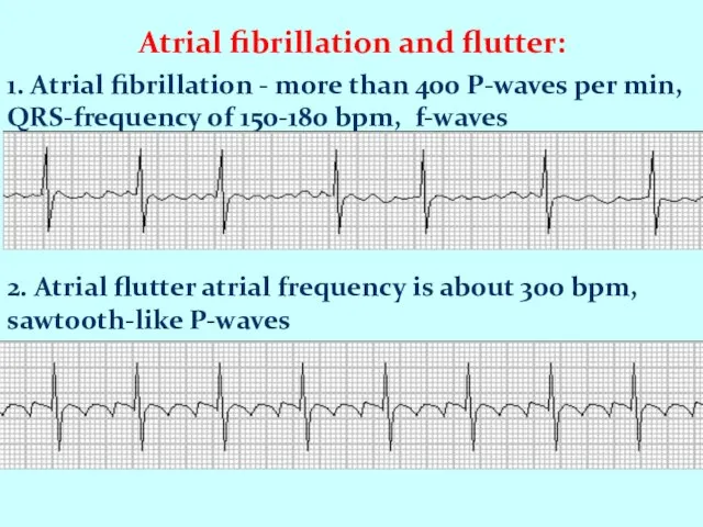 Atrial fibrillation and flutter: 1. Atrial fibrillation - more than 400