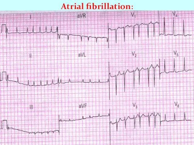 Atrial fibrillation: